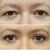 Otevřené a méně unavené oči - blefaroplastika horních víček