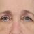 Brow lift, MUDr. Klosová Hana