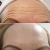 Botox na jedničku - čelo fotky