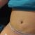 Abdominoplastika v Aesthevita