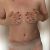 Abdominoplastika v Aesthevita