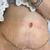 Abdominoplastika - fotky v časovém pásmu