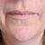Zjemnění vrásek kolem úst kyselinou hyaluronovou u MUDr. Vojtíškové