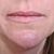 Zjemnění vrásek kolem úst kyselinou hyaluronovou u MUDr. Vojtíškové