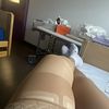 Laserová operace křečových žil a sklerotizace. Provedeno na Giaclinic Prostějov.