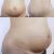 Sešití diastázy, operace kýly a abdominoplastika - Dr. Martin Chorvát, Vinohrady