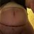 Dobrý den, abdominoplastika + pupeční kýla, MUDr. Ludevít Pintér