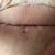 Dobrý den, abdominoplastika + pupeční kýla, MUDr. Ludevít Pintér