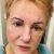Facelift + necklift, Mudr Kulhánek