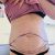 Abdominoplastika s liposukci