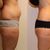 Procedura SlimLipo po porodu 