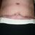 Problémy s vyprazdňováním po abdominoplastice, bolesti