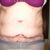 Problémy s vyprazdňováním po abdominoplastice, bolesti