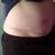 Abdominoplastika s liposukcí - fotky