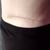 Abdominoplastika s liposukcí - fotky