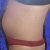 Liposukcia, miniabdominoplastika, facelift