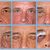 muž, 74 let, korekce horních očních víček
