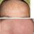 Odstranění pigmentových skvrn v obličeji - fotky