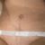 Abdominoplastika, 35 let po dvou císařských řezech