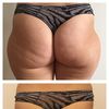 Liposukce vnějších stehen