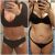 Úžasný výsledek abdominoplastiky - 100% spokojenost