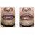 Gullwing lip lift - trvalé zvětšení horního rtu