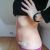 Recenze MUDr. Kydlíček abdominoplastika