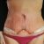 Recenze MUDr. Kydlíček abdominoplastika