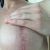Augmentace s modelací, 31 let