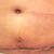 Ostrava: 3 týdny po abdominoplastice u MUDr. Zakouta