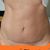 46 let, miniabdominoplastika, velká spokojenost