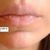 Gullwing lip lift - trvalé zvětšení horního rtu
