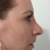 Reoperace, Rhinoplastika, velká špička nosu po operaci.