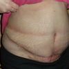 Sraženina po abdominoplastice