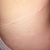 Kýla v jizvě / abdominoplastika