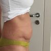 Cvičení měsíc po abdominoplastice