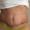Cvičení měsíc po abdominoplastice