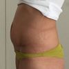 Cvičení měsíc po abdominoplastice