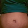 Ošklivá jizva a bolest 6 měsíců po abdominoplastice