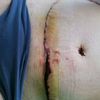 Špatně se hojící rána po abdominoplastice
