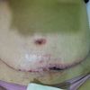Špatně se hojící rána po abdominoplastice