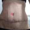 Důlek u pupíku po abdominoplastice - normální?