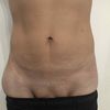 Miniabdominoplastika nebo klasická abdominoplastika po velkém zhubnutí?