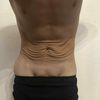Miniabdominoplastika nebo klasická abdominoplastika po velkém zhubnutí?