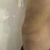Miniabdominoplastika nebo klasická abdominoplastika po velkém zhubnutí?