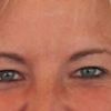 Reoperace očních víček - vykulené oči