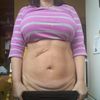 Strašní mě špatným hojením při abdominoplastice
