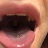 Odstranění jizvy po piercingu jazyka