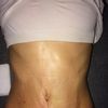 Jizva 5.týden po abdominoplastice