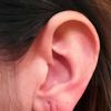 Korekce náušnicí poškozených ušních lalůčků